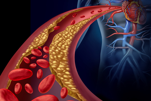 Clogged artery and atherosclerosis disease medical concept with a three dimensional human artery with blood cells that is blocked by plaque buildup of cholesterol as a symbol of arteriosclerotic vascular diseases.